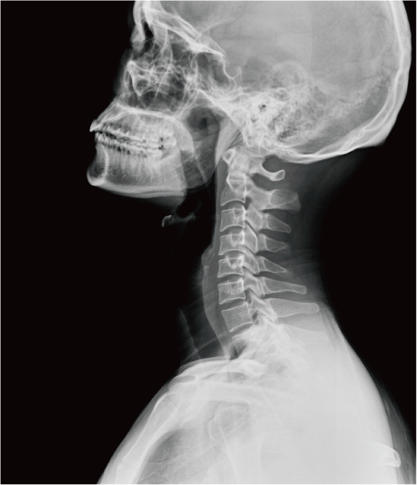 Lateral radiographic view (X-ray) of the cervical spine in an adult