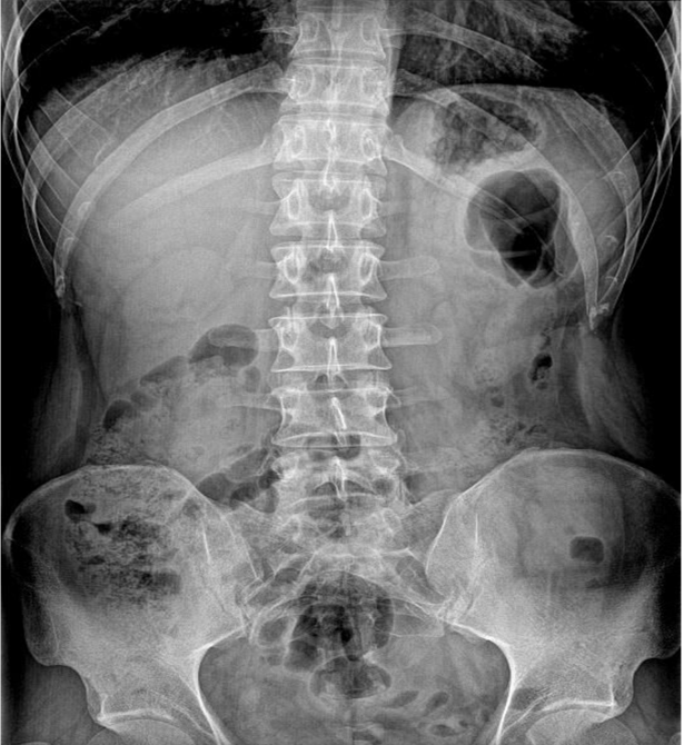 Anteroposterior (AP) radiographic view of the lower thoracic spine, lumbar spine, and pelvis in an adult