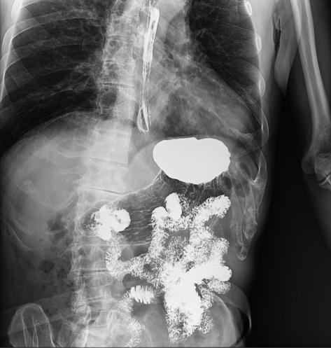 "Clinical X-ray image from an upper gastrointestinal (GI) and small bowel follow-through barium study